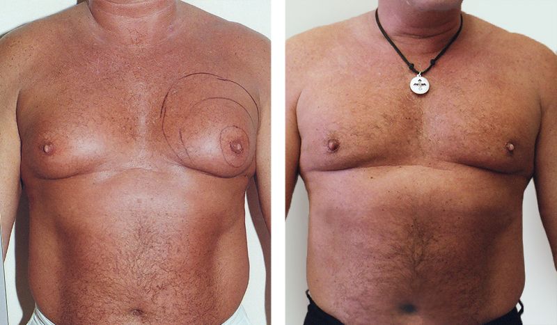 gynecomastia enlarge male breast